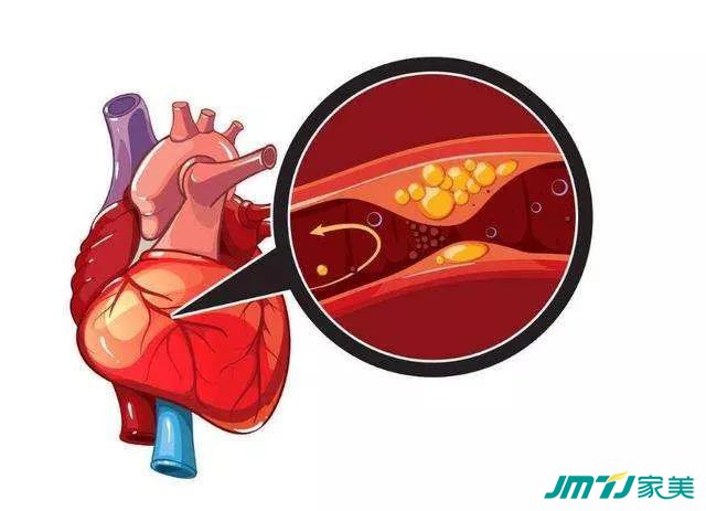 悲痛！58岁老戏骨因心梗抢救无效去世，预防心梗做好这7点