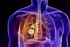 低剂量螺旋CT：能够发现可以治愈的早期肺癌